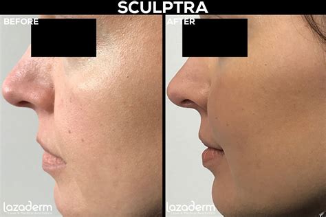 Juvederm Cheeks Before And After Photos