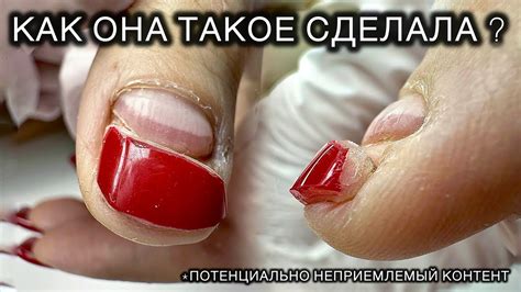 ИСТОРИЯ ОДНОГО (ИЛИ ВСЕ ТАКИ ДВУХ) НОГТЕЙ #подолог #подология # ...