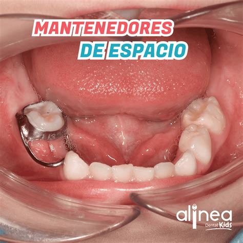 O Que Significa Mantenedores - Mantenedores de Espacio en Niños - Clínica ALINEA