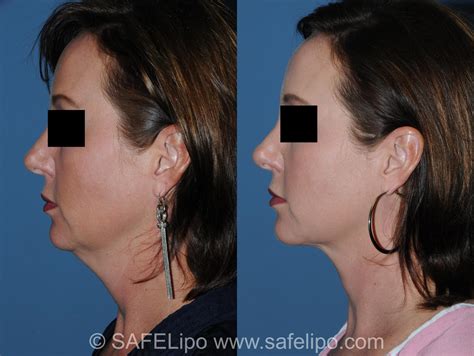 Double Chin Reduction Before and After Pictures Case 349 | SAFELipo®