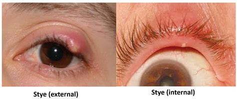 Swollen Eyelid Know The Causes Remedies And Alert Signs