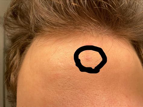 pimple won’t go away. help! : r/DermatologyQuestions