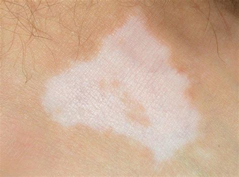 Manchas De Fungos Na Pele - Fungo Preto Na Pele : Fungos Na Pele Podem Causar Micose Medico ...