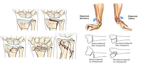 Перелом кисти: симптомы, первая помощь и лечение