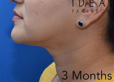 chin neck ideal face  body