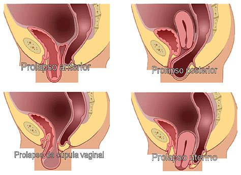 O Que É Prolapso Vaginal - Classificacao Do Prolapso Vaginal Prolapso Genital: O Que é? Como