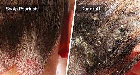 WebMD explains the differences between dandruff and scalp psoriasis ...