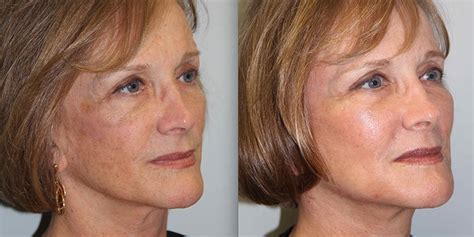 How much does a mini facelift in Tijuana Mexico cost? - Top Surgeons Mexico