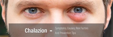 Chalazion- Symptoms, Causes, Risk Factors and Prevention Tips