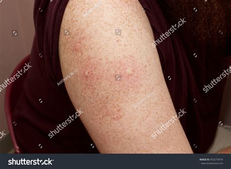 Intradermal Allergy Skin Test Results Right Stock Photo 453275974 ...