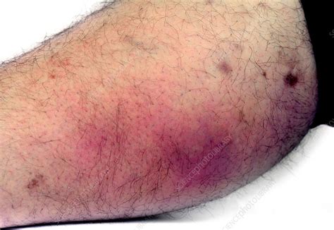 Cellulitis - Stock Image - C019/7565 - Science Photo Library