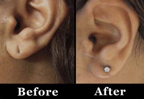 Ear Lobe Hole Repair | Svelte Medical Weight Loss