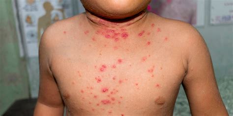 O Que É Moluscos Contagiosos - Qué Son Y Por Qué Se Producen Los Moluscos Contagiosos – DDKGWB