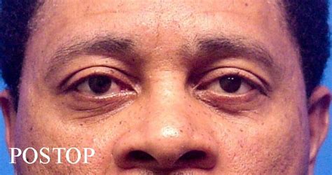 Eye Removal (Enucleation) gallery » Dallas Ophthalmology Surgeons ...