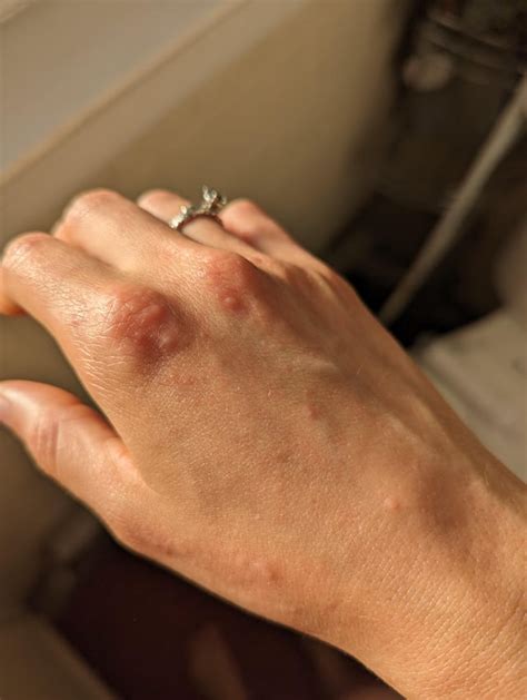 Lamictal rash after REDUCING dosage? : r/Lamotrigine