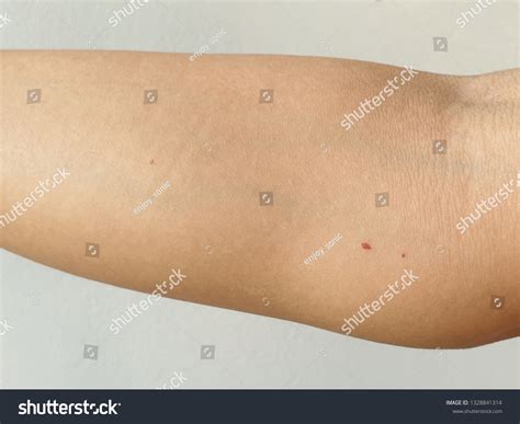 Cherry Angiomas Red Mole Red Mark Stock Photo (Edit Now) 1328841314