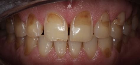 enamel erosion cheryl  siegel dds