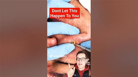 This Unbelievable Blackhead Removal 2024 Method is Taking Over TikTok! - prb5kxt