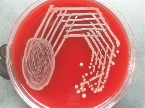 Kingella case report: Patient history, Lab diagnosis and treatment