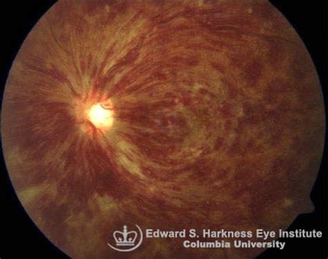 central retinal vein occlusion vagelos college  physicians  surgeons