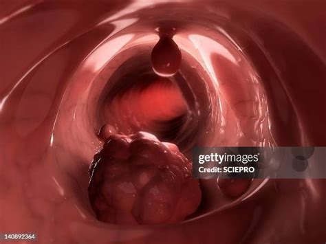 cancer polyp stock  high res pictures  images getty images