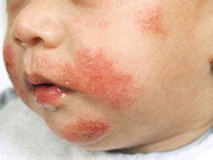 Allergy testing causes of eczema and dermatitis in London