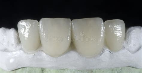 Ceramic crown stock photo. Image of healthy, dentistry - 64921990