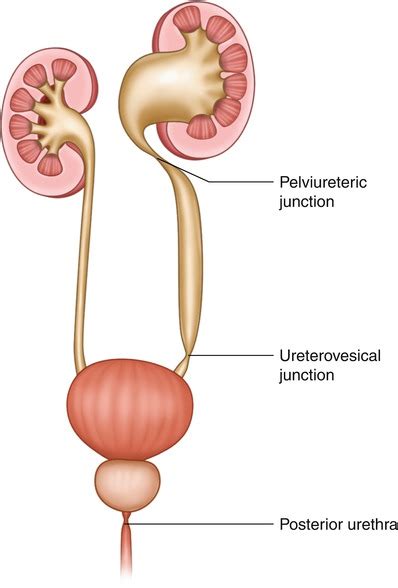 PUJ Obstruction : What Is It, Symptoms, Diagnosis and Treatment |Dr. Ali