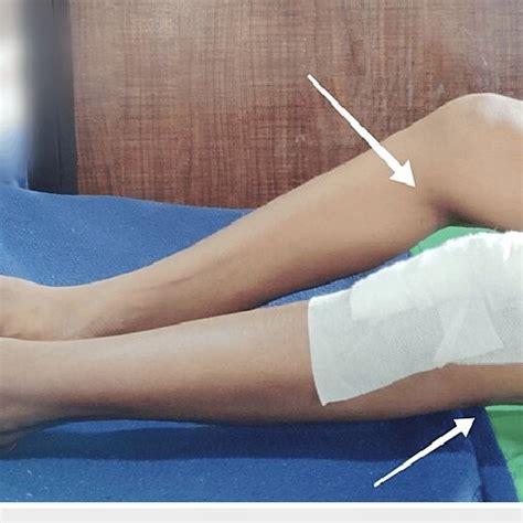 Fixed flexion deformity of knee joints | Download Scientific Diagram