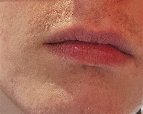 Extreme blackheads extraction can cause permanent scarring if done incorrectly 17