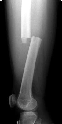 Femur Shaft Fracture | Boston Medical Center