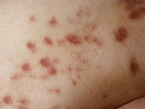 Diabetes Itchy Rash Treatment at Kelli Johnson blog