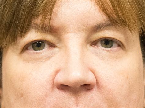 upper eyelid    kotis