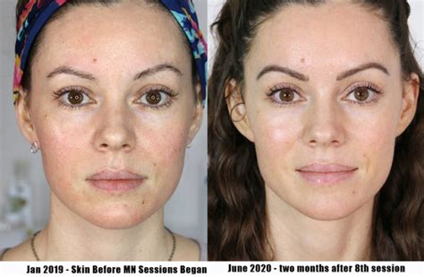 Microneedling Before and Afters - 8 Treatments (16 Mos.) – Life and DIY