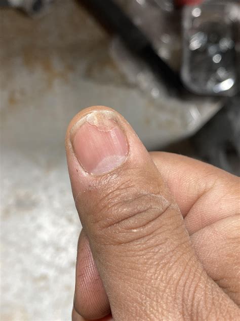 Split nail : r/nailhealth