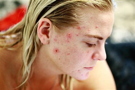 severe acne treatment