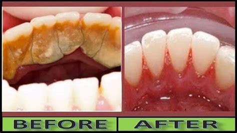 How to Remove Tartar from Teeth Yourself? - 3 Minutes Hack! – Franklin ...