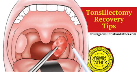 tonsillectomy recovery tips courageous christian father