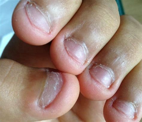 Nail Abnormalities: Causes, Symptoms, And Pictures, 40% OFF