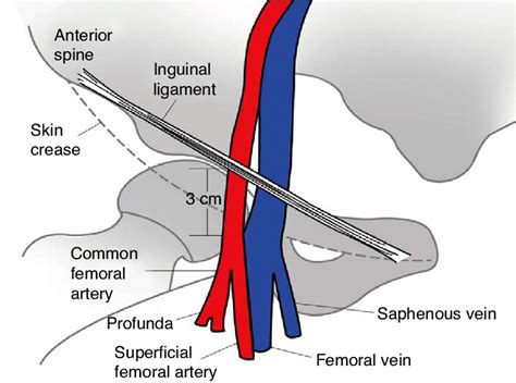 The anatomy relevant to percutaneous catheterization of the femoral ...