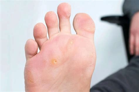 Management of Corns on Feet