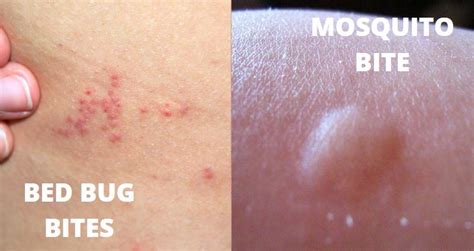 bed bug  mosquito bites   points explained   p