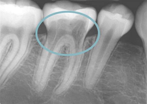 External Root Resorption | Atlas Dental, Toronto Dentist