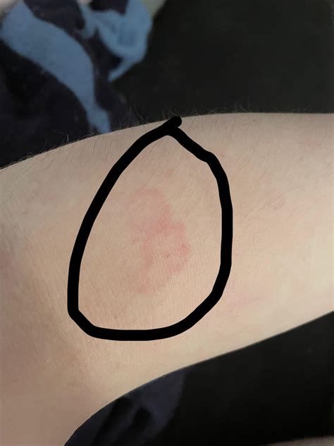 Start of ringworm?? : r/medical_advice