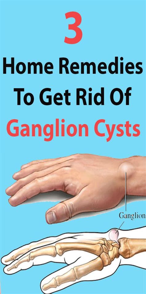 How Do You Get Rid Of A Ganglion Cyst On Your Foot - Chris Mehl Kapsels