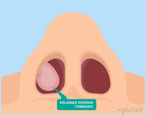 Turbinate hypertrophy ear ent cpap nose stop apnea block laser posters ...