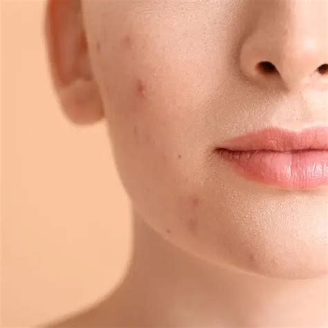Stagnant red spots after acne: how to remove red spots on the face at home