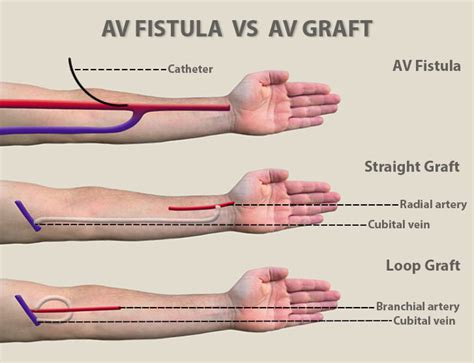 AV Fistula vs. AV Graft - Vein & Endovascular Medical Care