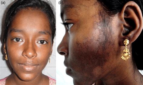 photograph   face  skin rashes sparing  bridge
