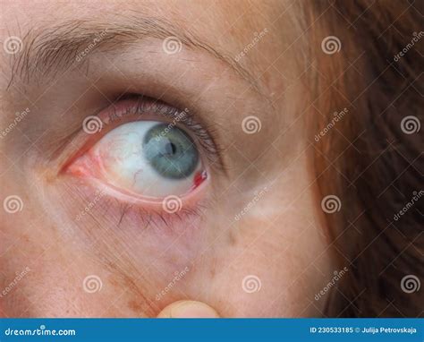 Subconjunctival Hemorrhage or Subconjunctival Bleeding, Hyposhagmus ...